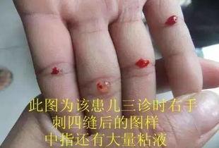 成人挑疳积视频大全,揭秘成人常见病症的防治之道-第1张图片-抖抈免费版app