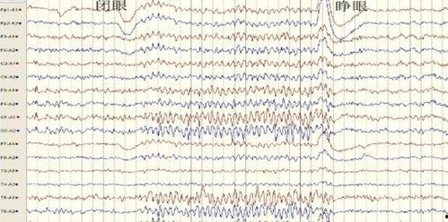 成人脑电图操作视频教程-第1张图片-抖抈免费版app 成人脑电图操作视频教程-第1张图片-抖抈免费版app