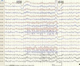 成人脑电图操作视频教程-第2张图片-抖抈免费版app 成人脑电图操作视频教程-第2张图片-抖抈免费版app