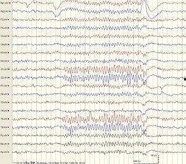 成人脑电图操作视频教程-第3张图片-抖抈免费版app 成人脑电图操作视频教程-第3张图片-抖抈免费版app