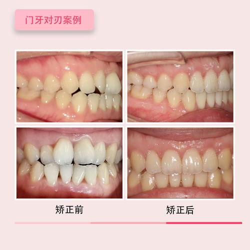 成人深覆盖矫正视频,视频教程全解析-第1张图片-抖抈免费版app